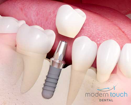 Dental implant